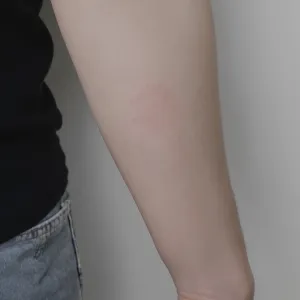 Forearm